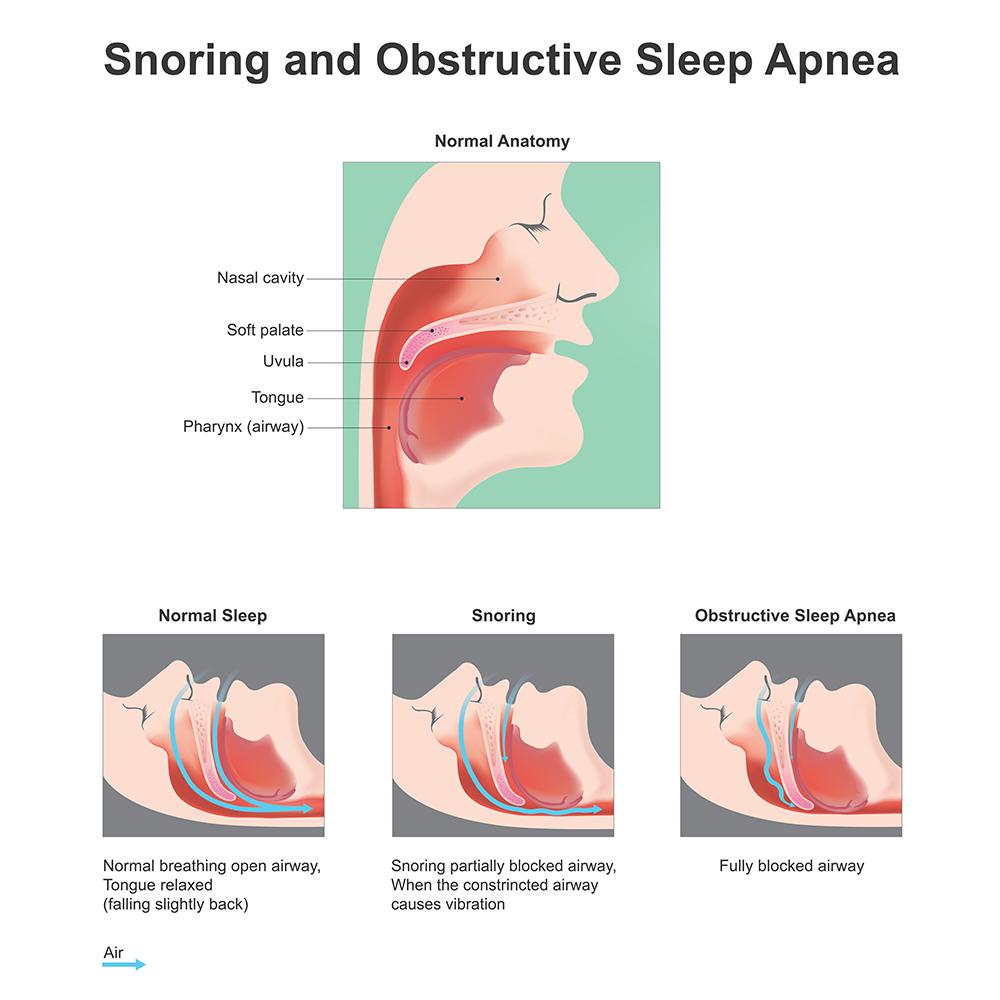 snoring and obstructive sleep apnea