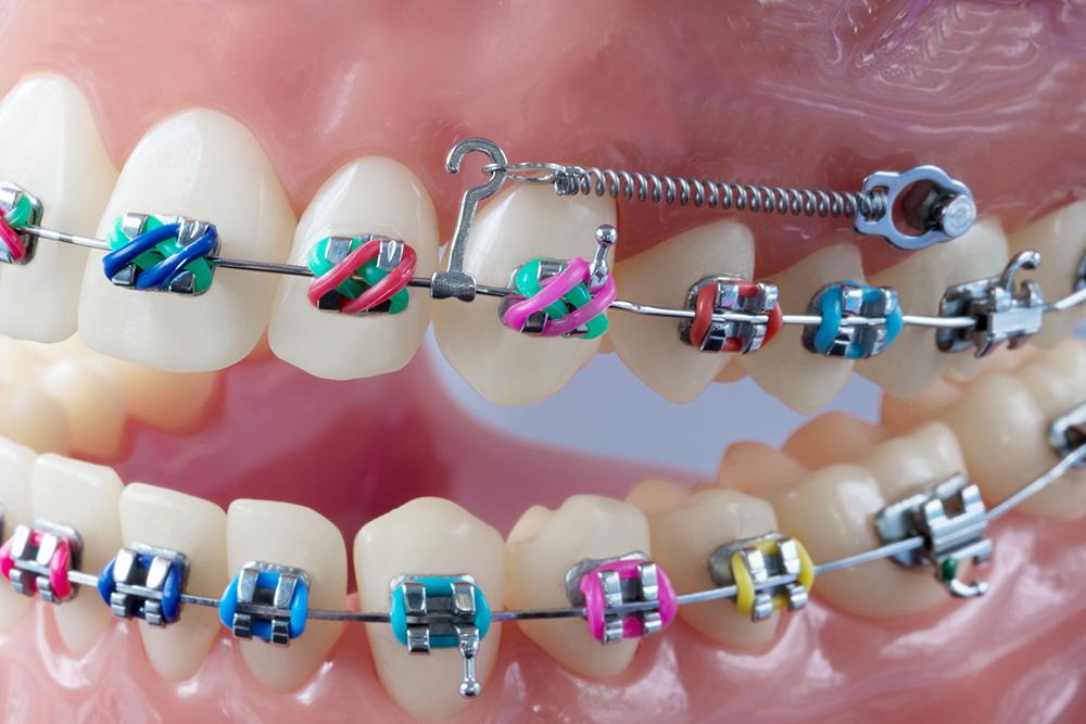 temporary anchorage devices: phoenix oral & facial surgery