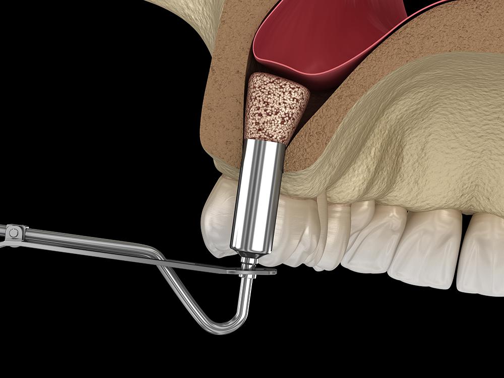 sinus lift procedure by Phoenix Oral & Facial Surgery