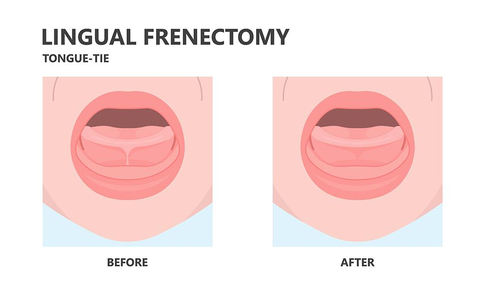 Phoenix oral surgery: frenectomy | tongue tie