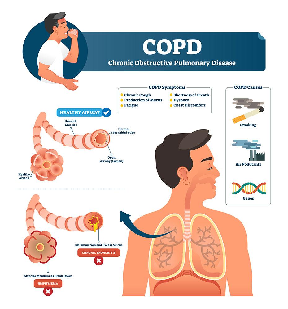 COPD and it's affects on oral surgery