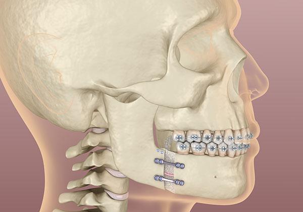 illustration of skeleton showing corrective jaw surgery