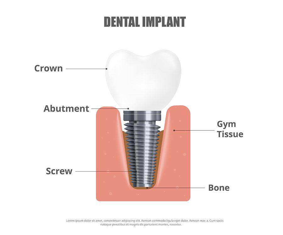 Image showing the different elements of a dental implant placement