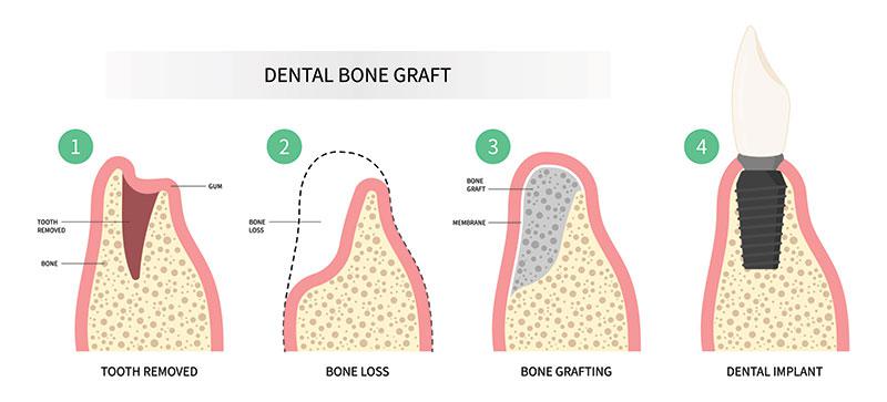 infographic of a dental bone graft