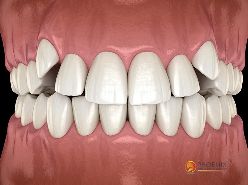 impacted canine teeth