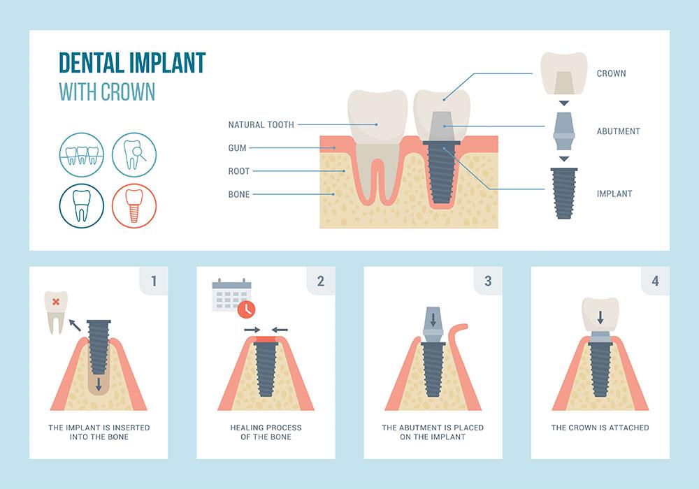 Image of the 7 stages of implant placement with crown