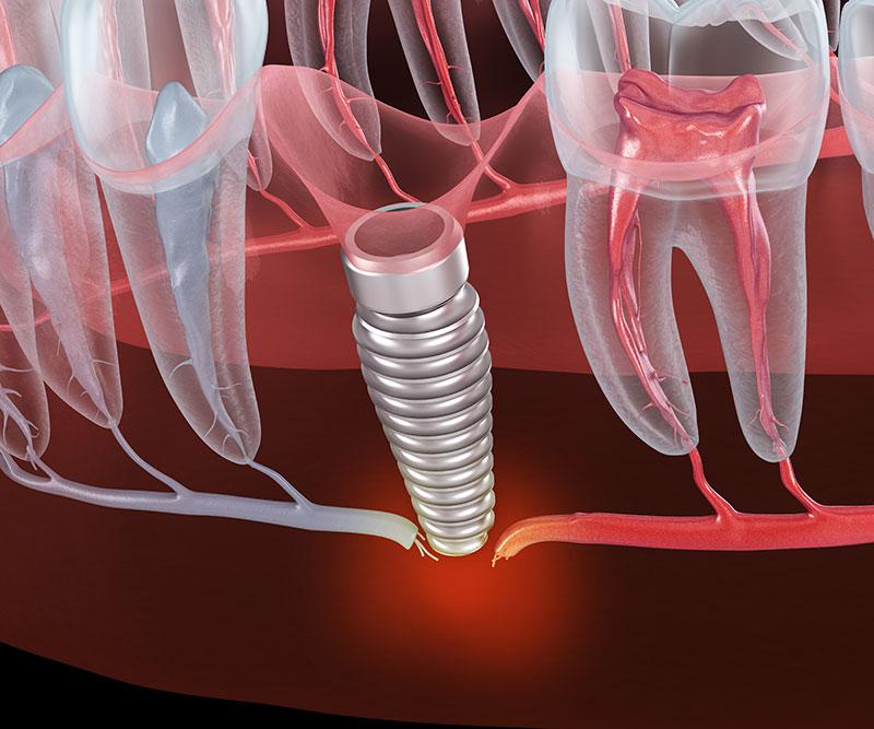 Common reasons why dental implants fail