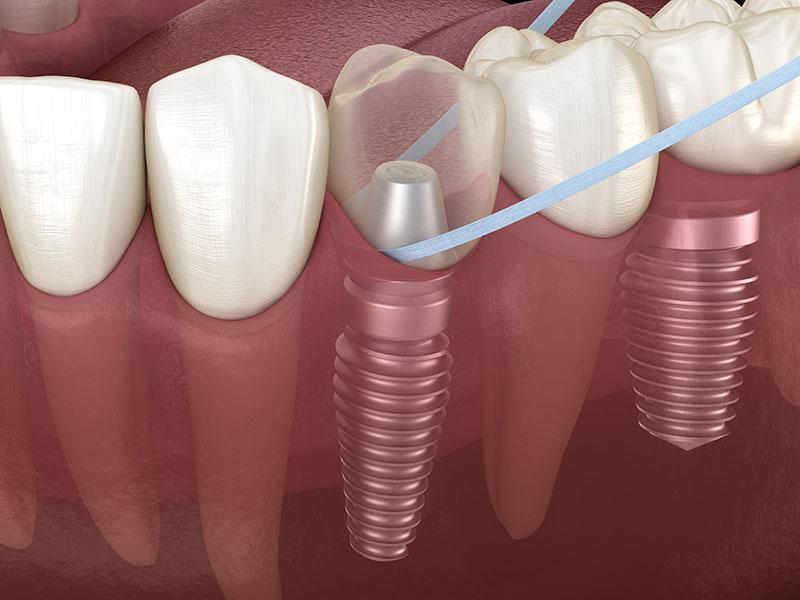 Maintaining healthy dental implants with proper cleaning and flossing