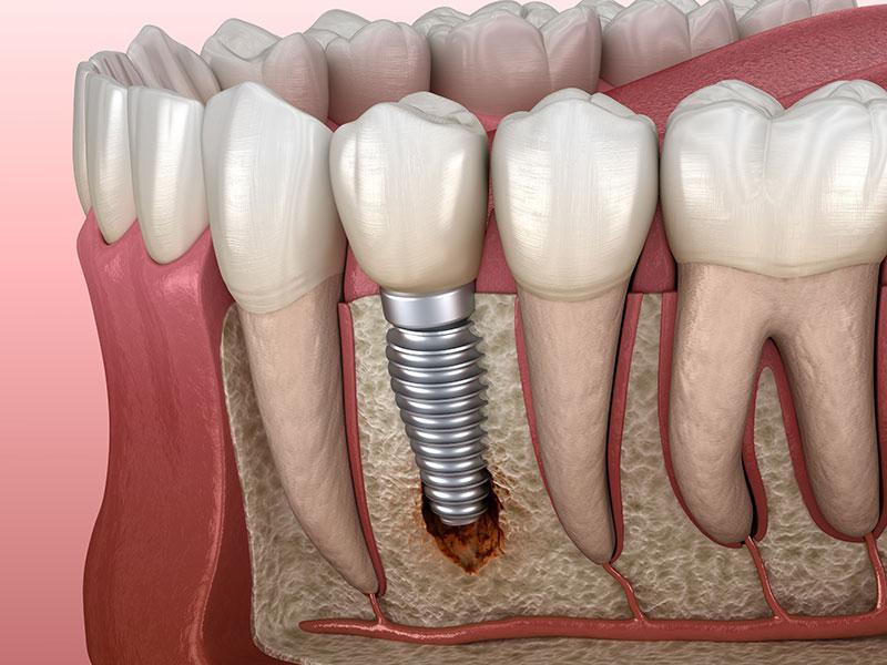 infected dental implant from Periimplantitis with visible bone damage