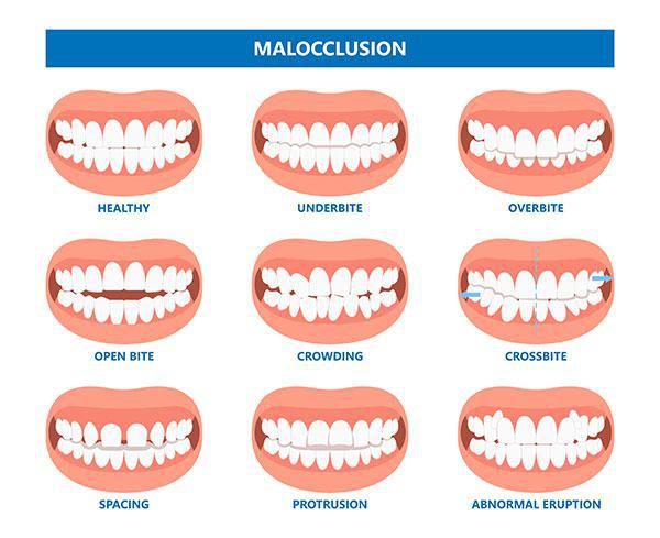 malocclusion infographic of symptoms for needing corrective jaw surgery