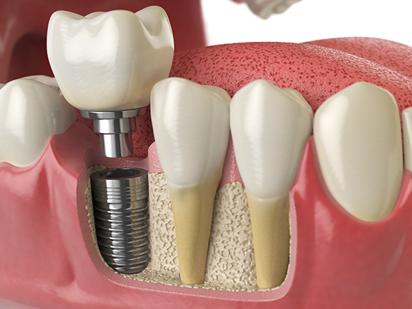 Dental Implants Phoenix, AZ: Oral & Facial Surgery