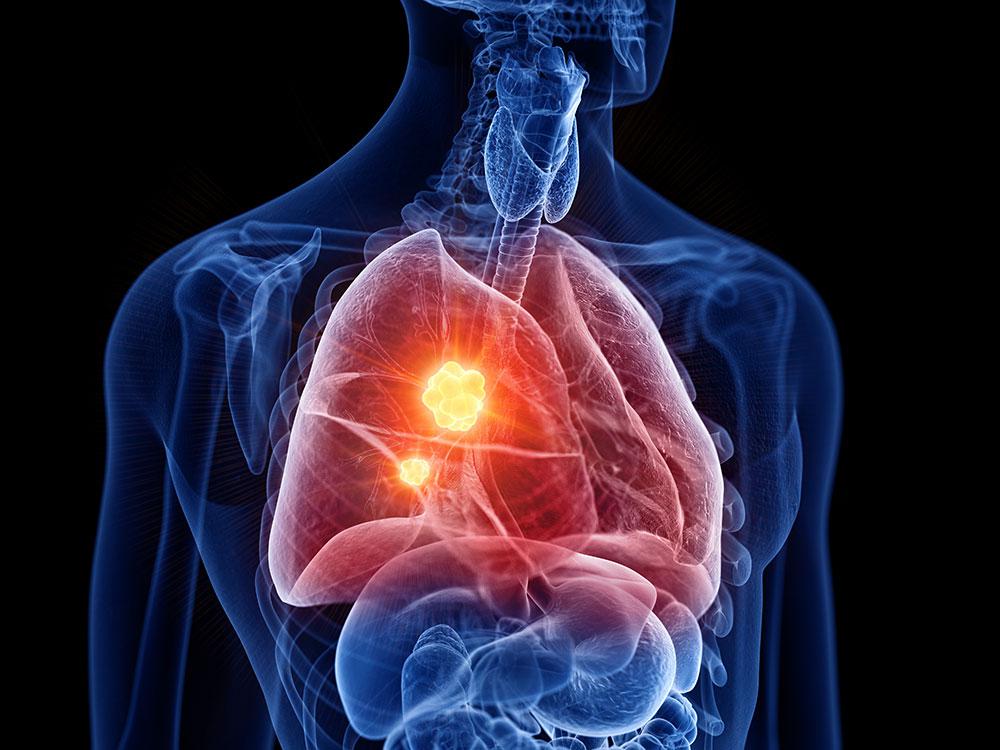 chronic obstructive pulmonary disease in oral surgery