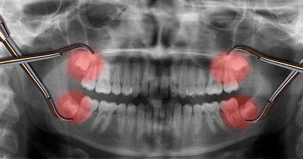radiograph x-ray of wisdom teeth