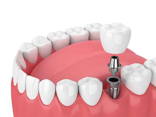 Why is getting dental implants after extraction important?