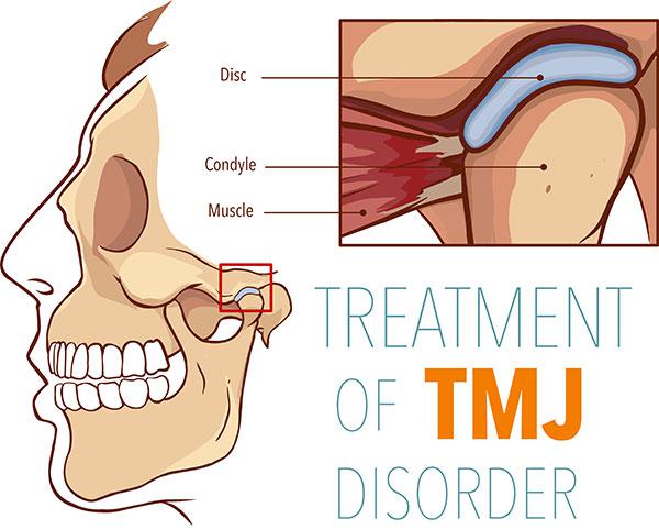 treatment for TMJ in Phoenix Arizona
