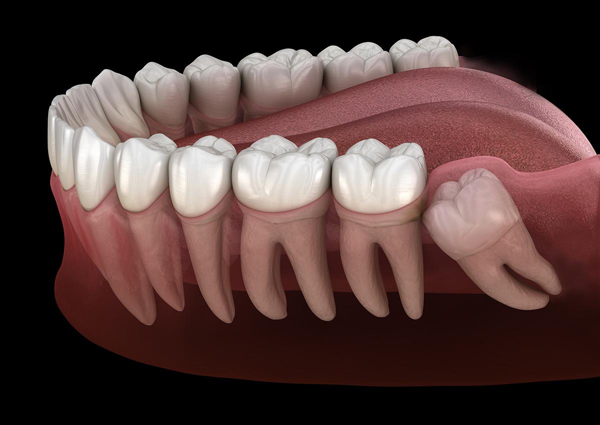infographic of wisdom tooth at Phoenix Oral & Facial Surgery