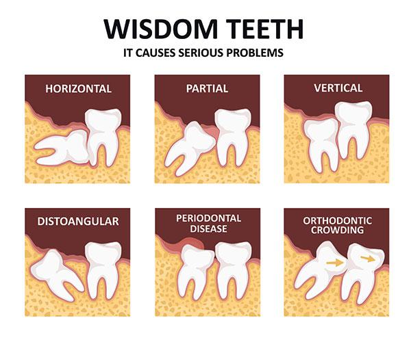 serious problems with wisdom teeth